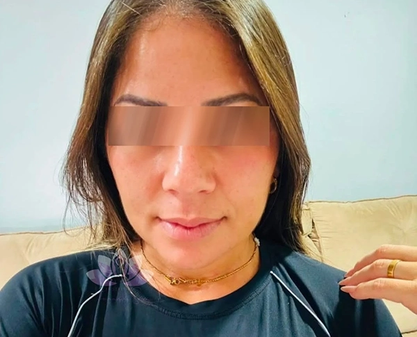 Resultado de tratamento facial depois do tratamento